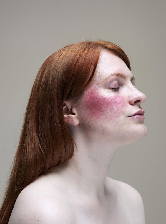 Rosacea: Symptoms, Causes, Triggers & Treatment